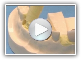 Mounting Teeth