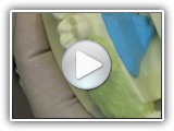Restoring Endo Treated Tooth